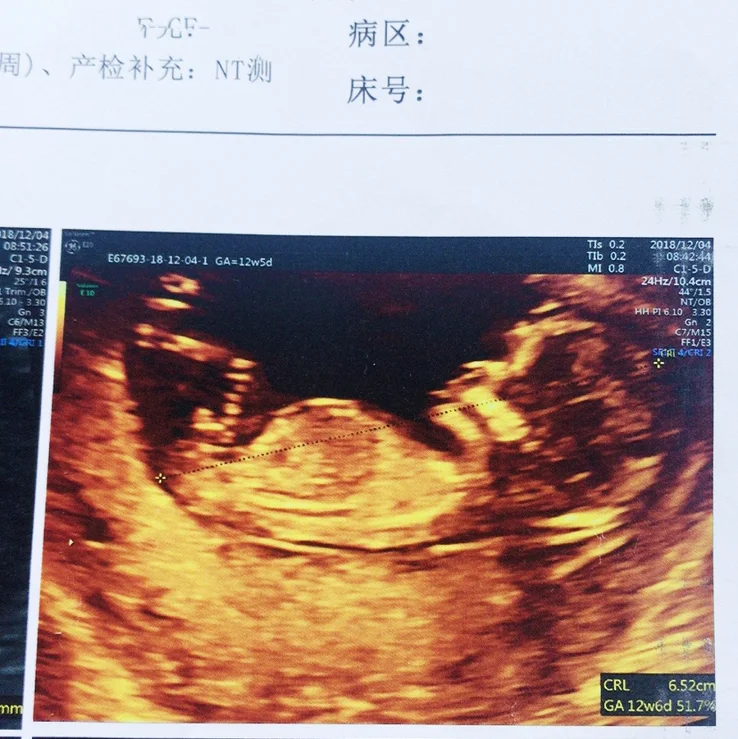 孕期产检 孕期高血糖有什么症状和危害