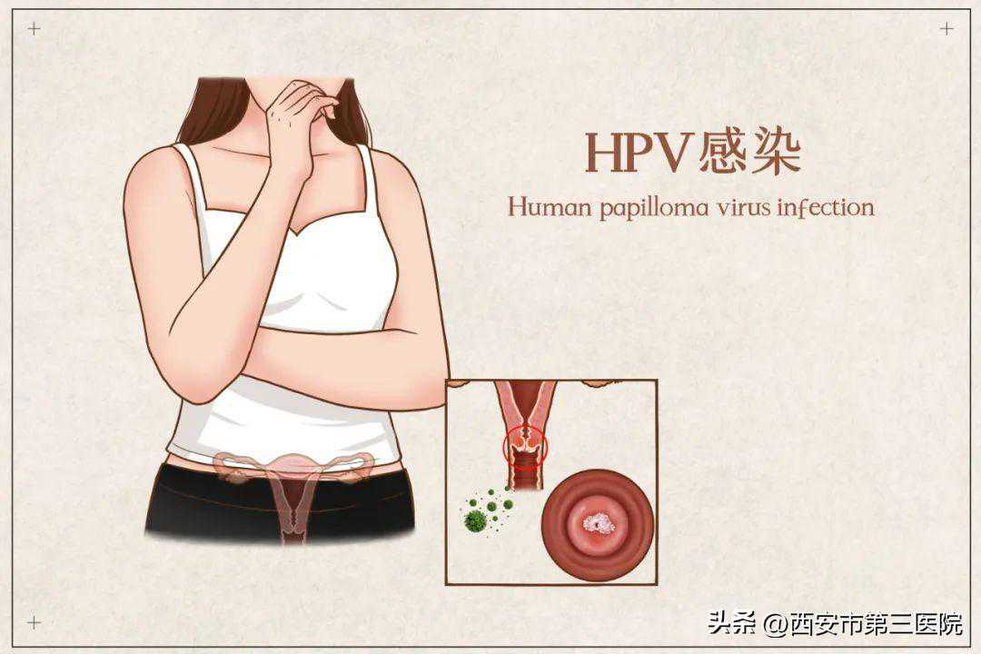 HPV疫苗全攻略｜二四九价疫苗选哪个？ 怎么打印新冠疫苗