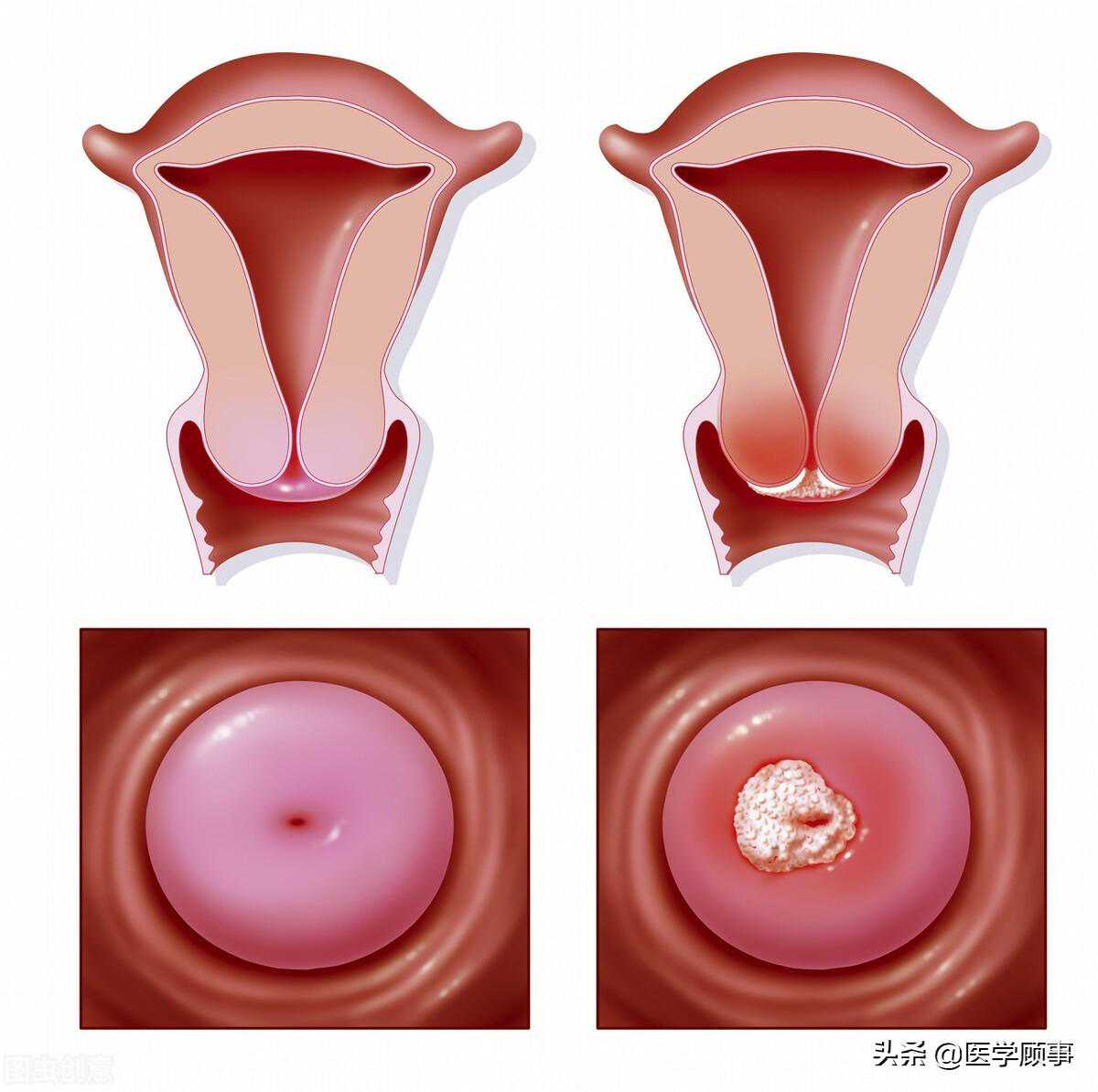 宫颈癌疫苗有必要打么？ 未接疫苗限制出行