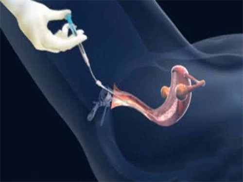 月经不规律试管移植方案介绍！月经不规律试管移植要注意什么