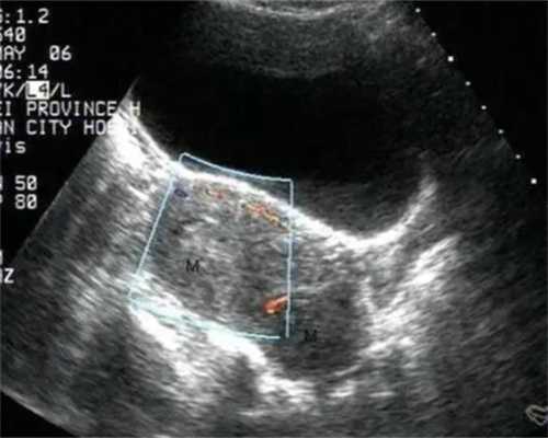 第三代试管适用人群解析：2025年生育选择的科学指南