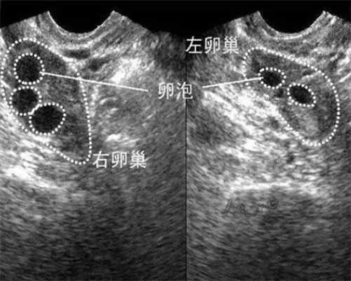 家庭生育的阶梯：从第一代到第三代试管婴儿的选择与影响