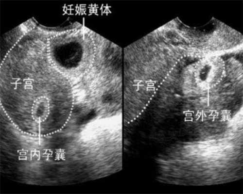 三代促排时间解析：了解取卵前的关键天数